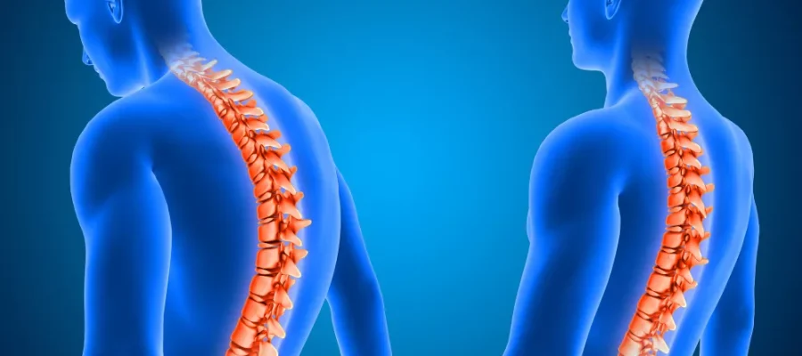 Skolyoz Nedir ?