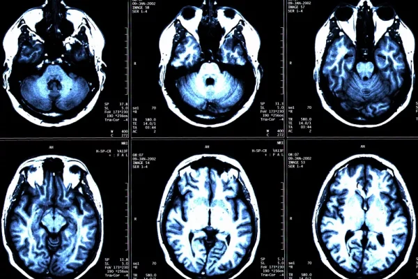 Brain Segmentation with Artificial Intelligence